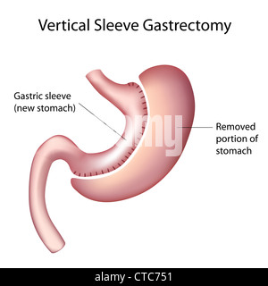 Gastrectomie verticale (VSG) Banque D'Images