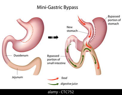 Mini gastric bypass surgery Banque D'Images