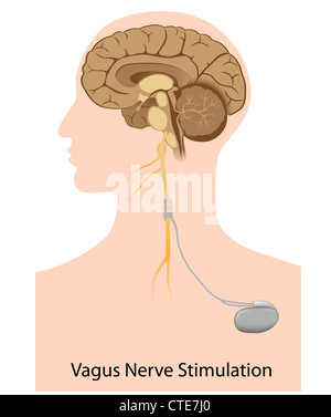 La thérapie de stimulation de nerf de Vagus Banque D'Images