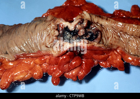 L'adénocarcinome du côlon. Spécimen de pathologie. Banque D'Images