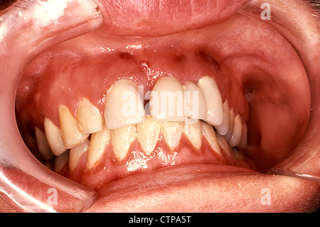 Gingival labial et sarcome de Kaposi chez un malade du SIDA. Banque D'Images