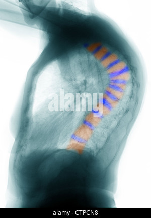 CT scan de la colonne thoracique d'une femme de 69 ans avec l'ostéoporose grave, et fractures par tassement de la colonne thoracique Banque D'Images