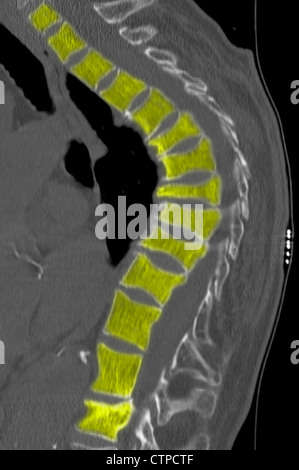 Colonne thoracique CT d'une femme de 69 ans avec l'ostéoporose. Banque D'Images