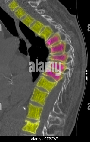 Colonne thoracique CT d'une femme de 69 ans avec l'ostéoporose. Banque D'Images