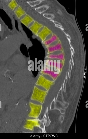 Colonne thoracique CT d'une femme de 69 ans avec l'ostéoporose. Banque D'Images