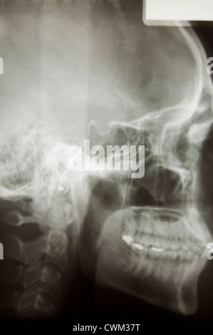 Close-up shot of X-ray film avec image de tête humaine Banque D'Images