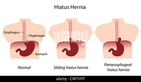 Les types courants d'hernie hiatale Banque D'Images