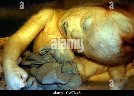 Foetus humain ( foetus ) dans Exomphalos état conservé dans du formol à Jar Medical College Hospital Inde ( échantillon original ) Banque D'Images