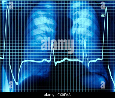 Rx des poumons d'un composite sur l'impression d'un électrocardiogramme. Banque D'Images