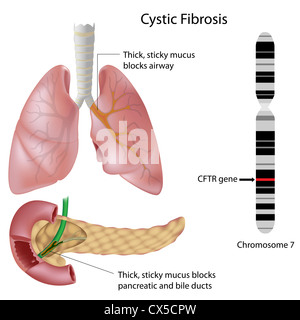 Fibrose kystique Banque D'Images