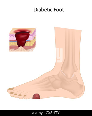 Pied diabétique Banque D'Images