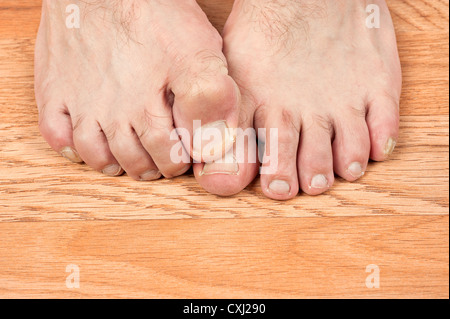 Un homme avec Itchy Feet utilise son gros orteil à zéro son autre pied. Bon pour les soins d'inférences. Banque D'Images