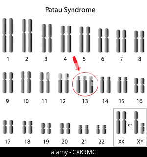 Syndrome de Patau, trisomie 13 Banque D'Images