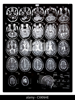 La tomodensitométrie, scanner de la tête d'une jeune femme qui a la sclérose en plaques, MS, Banque D'Images