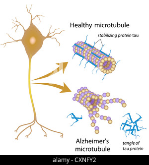 Les microtubules qui se désagrègent dans la maladie d'Alzheimer Banque D'Images