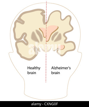 La maladie d'Alzheimer cerveau par rapport à la normale Banque D'Images