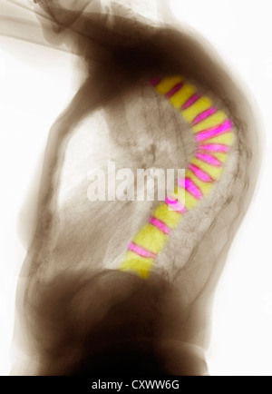 De CT scan thoracique à l'ostéoporose Banque D'Images