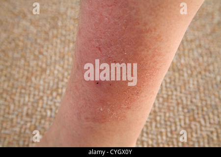 Close up grandes de l'eczéma sur la jambe d'une femme âgée Banque D'Images