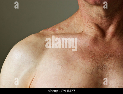 Cicatrice sur l'homme d'âge moyen de l'épaule où une grande lipome a été enlevé chirurgicalement. Banque D'Images