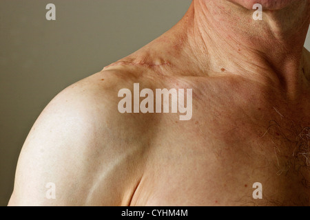 Cicatrice sur l'homme d'âge moyen de l'épaule où une grande lipome a été enlevé chirurgicalement. Banque D'Images