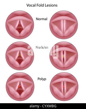 Les lésions des cordes vocales Banque D'Images