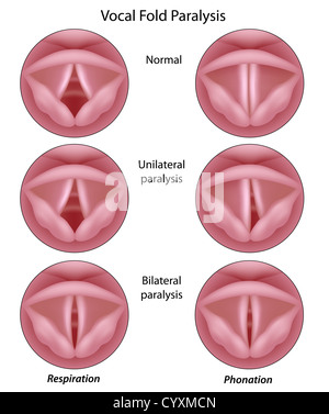 La paralysie des cordes vocales Banque D'Images