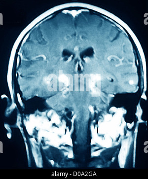 La maladie de Parkinson, l'IRM Banque D'Images