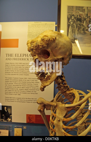 Réplique du squelette de Joseph Merrick, The Elephant Man, le Royal London Hospital Museum, Whitechapel, London, UK. Banque D'Images