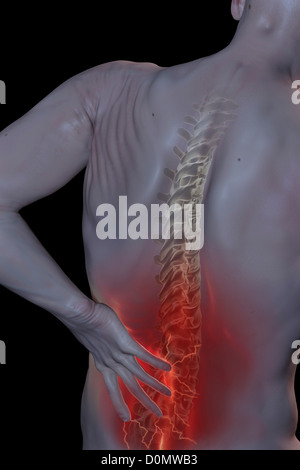 Modèle anatomique montrant l'inflammation de la zone touchée par la douleur au dos. Banque D'Images