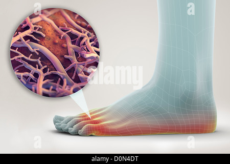 Un pied gauche wireframe apparence. pied est mis en évidence la présence représentent l'infection fongique connu sous le pied d'athlète. Banque D'Images