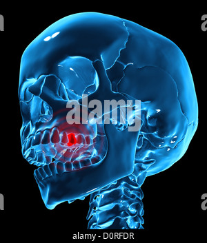 Odontalgie illustration médicale Banque D'Images