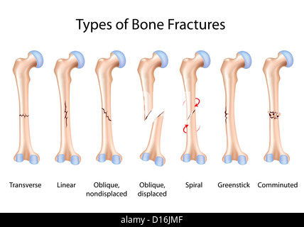 Types de fractures des os Banque D'Images