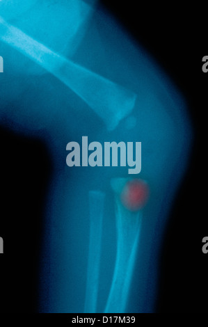 La syphilis congénitale : genou xray de nouveau-né Banque D'Images