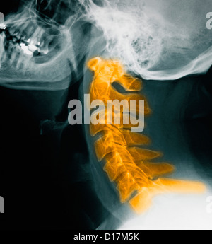Des radiographies de la colonne cervicale, normal Banque D'Images