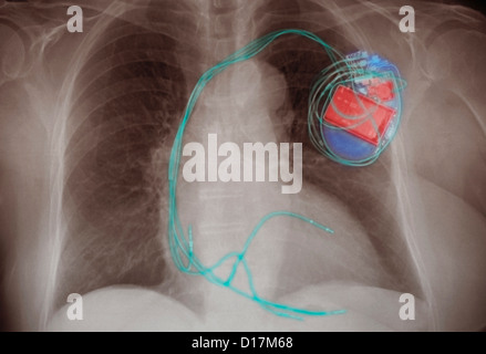 Radiographie montrant un stimulateur implanté Banque D'Images