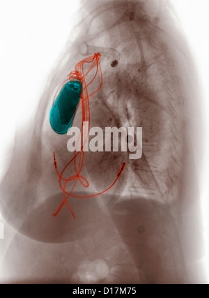 Radiographie montrant un stimulateur implanté Banque D'Images