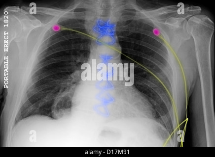 La radiographie de la chirurgie cardiaque, moniteur câbles, hernie hiatale Banque D'Images