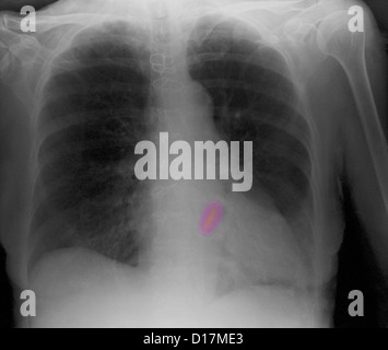 La radiographie d'une femme âgée, remplacement de valve cardiaque Banque D'Images