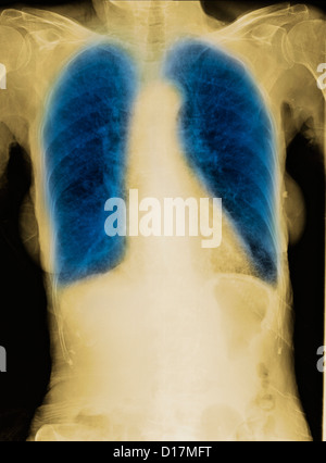 La radiographie d'une femme âgée fumeur avec la MPOC Banque D'Images