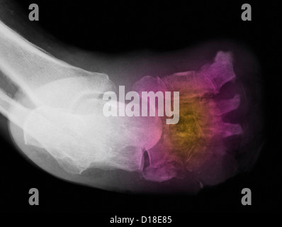 X-ray montrant l'amputation pour le diabète Banque D'Images