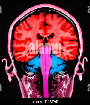 Section sagittale IRM de cerveau normal Banque D'Images