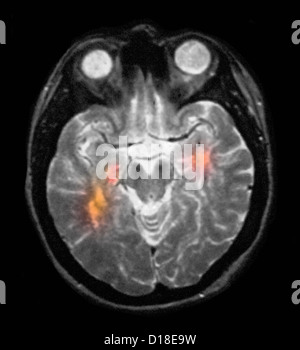 L'IRM cérébrale montrant la sclérose en plaques Banque D'Images