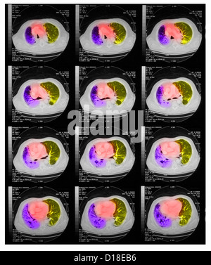 Scanner thoracique, carcinome à petites cellules, la pneumonie Banque D'Images