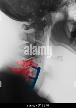 Xray montrant l'arthrodèse cervicale, C5, C6, C7 Banque D'Images