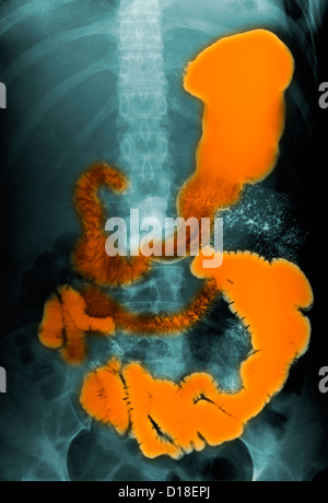 L'abdomen du petit intestin X-ray Banque D'Images