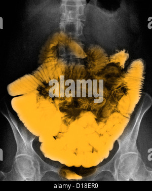 L'intestin grêle normal contraste baryté radiographie abdominale Banque D'Images