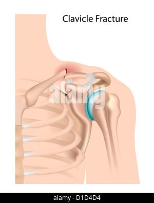 Fracture de la clavicule. Banque D'Images