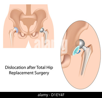 Après la dislocation de la hanche Banque D'Images