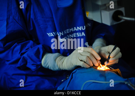 Un patient subissant une chirurgie de la cataracte dans une clinique mobile, Bali, Indonésie. Banque D'Images