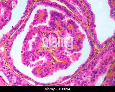 Le cancer de la thyroïde, de la lumière microphotographie Banque D'Images